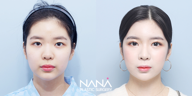 Liposuction Before & After — Before & After