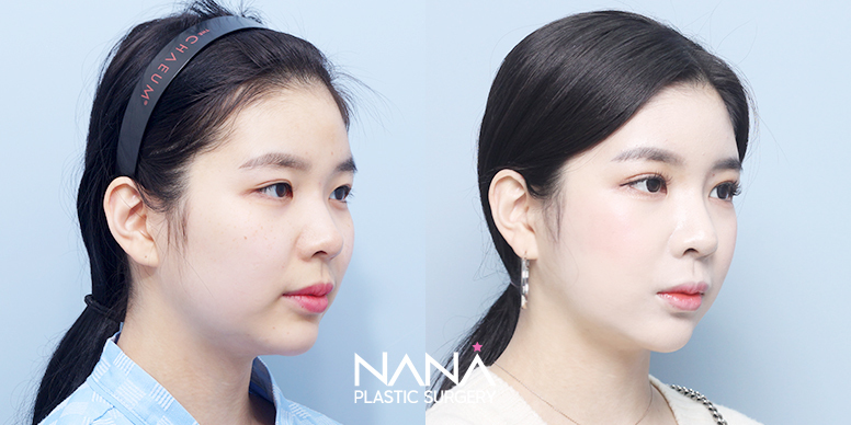 Before & After Before & After