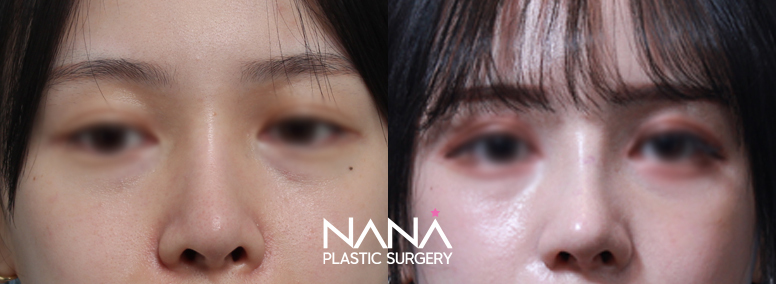 Before & After Before & After