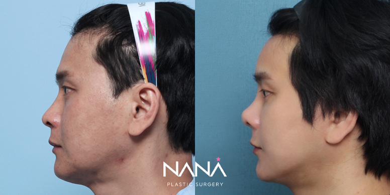 Before & After Before & After