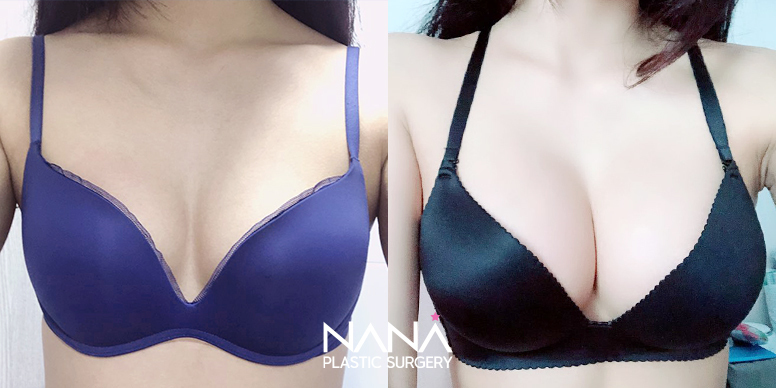 胸整形 症例写真 — 症例写真