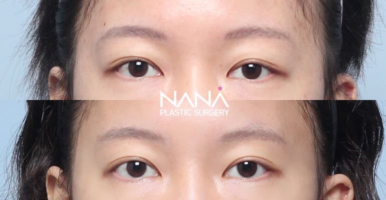 Eyes Before & After — Before & After