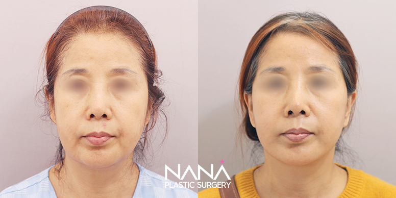 Lifting Before & After — Before & After