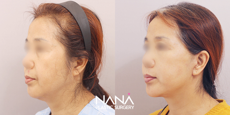 Before & After Before & After