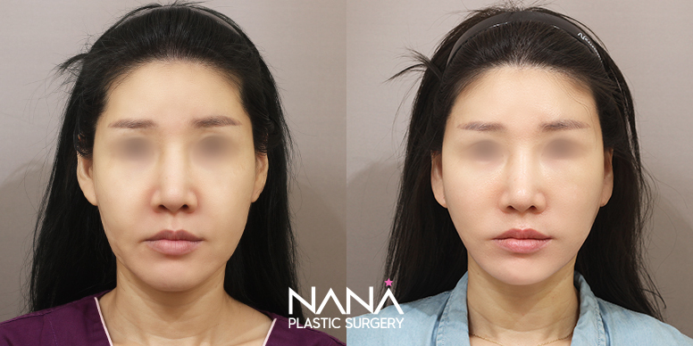 Before & After Before & After