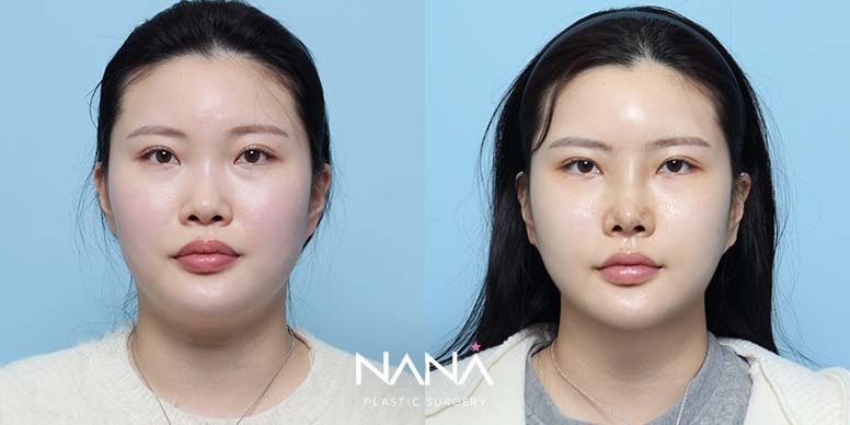 Before & After Before & After