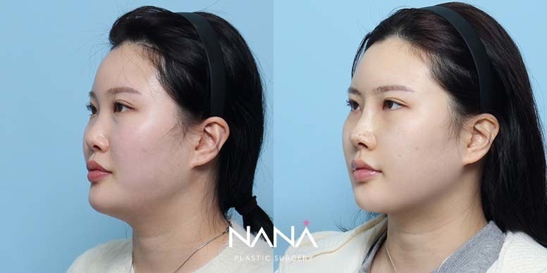 Before & After Before & After