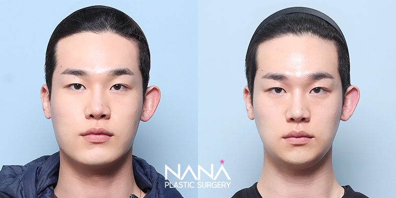 Facial Contouring Before & After — Before & After