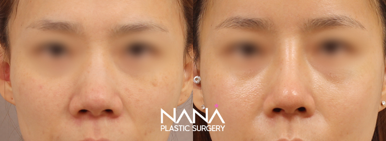 Nose Before & After — Before & After