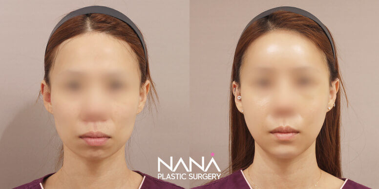 Facial Contouring Before & After — Before & After