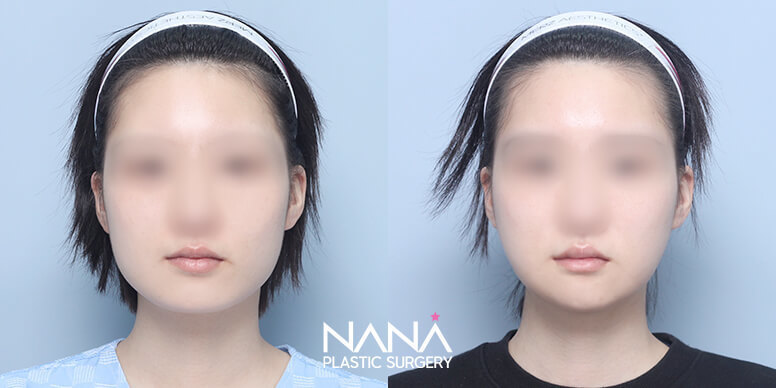 Facial Contouring Before & After — Before & After