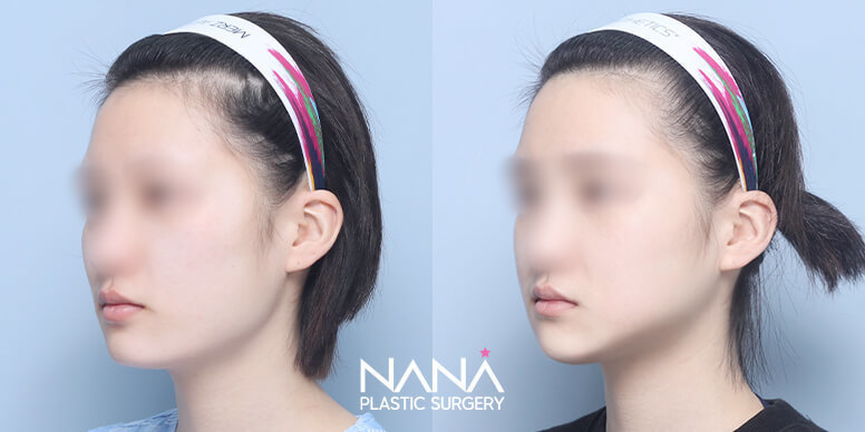 Before & After Before & After