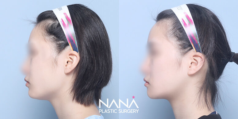 Before & After Before & After