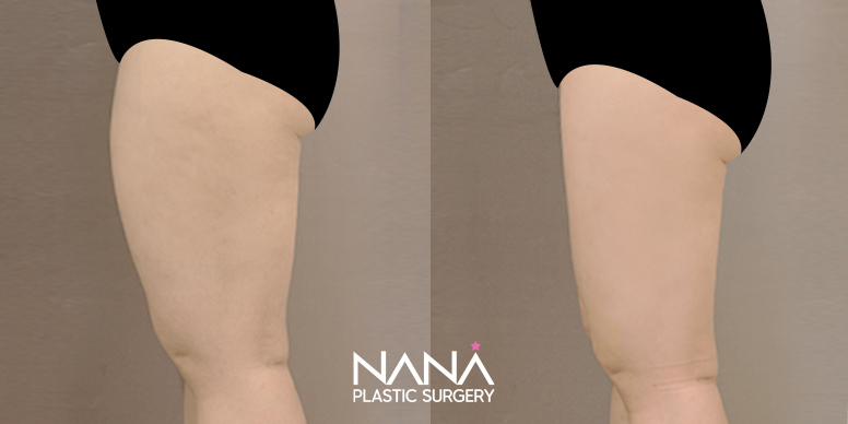 Liposuction Before & After — Before & After