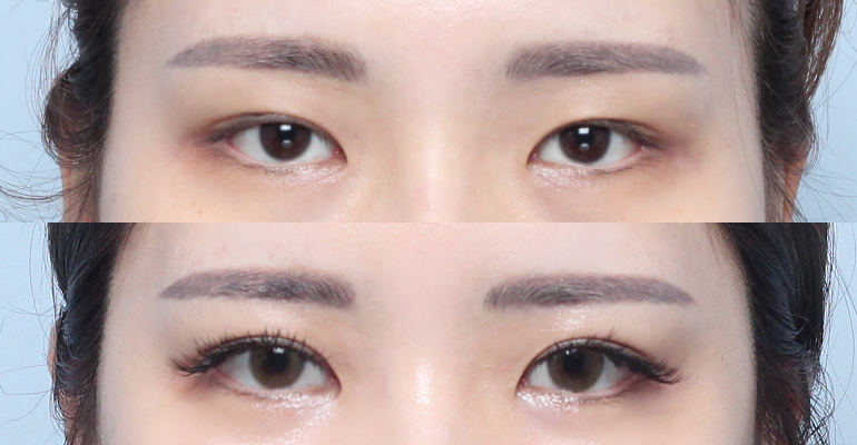 Eyes Before & After — Before & After