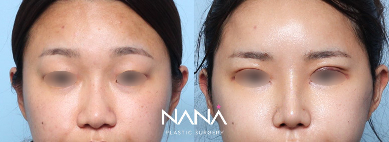 Before & After Before & After