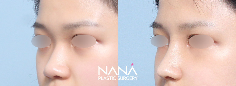 Хамар Өмнө ба дараа — Өмнө ба дараа