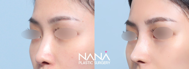 Nose Before & After — Before & After