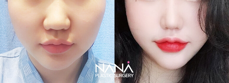 Facial Contouring Before & After — Before & After