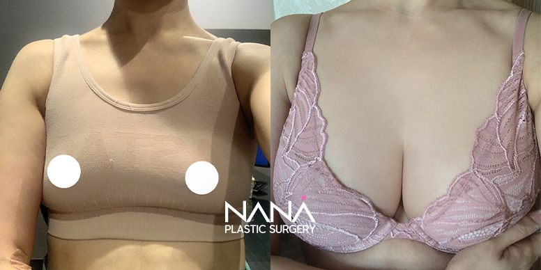 전후사진 전후사진