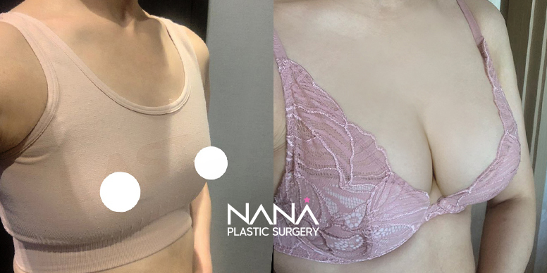 전후사진 전후사진