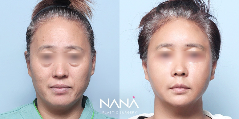 Lifting Before & After — Before & After
