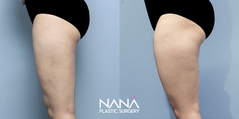 Liposuction Before & After — Before & After