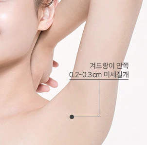 Minimal Incision dengan NANA Liposuction! - gambar detail