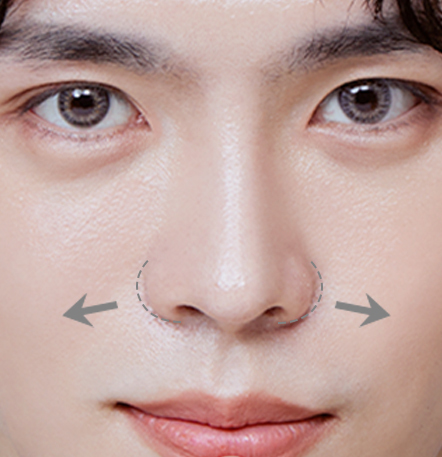 Male Rhinoplasty di NANA Plastic Surgery <br/><b>Direkomendasikan untuk yang menginginkan hasil seperti ini!</b> - gambar detail