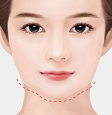 NANA Plastic Surgery<br/><b>Kapan Operasi Revisi Kontur Wajah Diperlukan?</b> - gambar detail