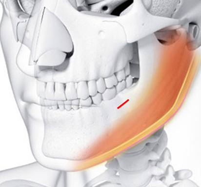 Penjahitan di Dalam Mulut - gambar detail