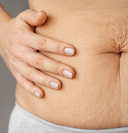NANA Plastic Surgery <b>Tummy Tuck</b> <b>Direkomendasikan untuk Siapa?</b> - gambar detail