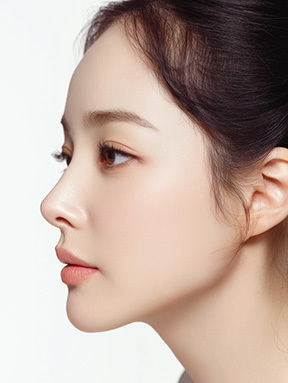Gambar hasil Operasi Revisi Kontur Wajah di NANA Plastic Surgery, menampilkan tampak samping dengan garis wajah yang ramping dan seimbang dari berbagai sudut.