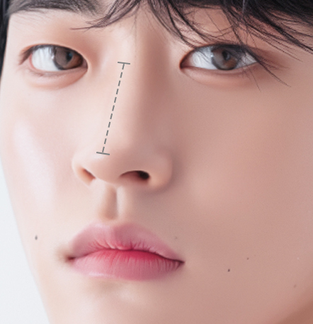 Male Rhinoplasty di NANA Plastic Surgery <br/><b>Direkomendasikan untuk yang menginginkan hasil seperti ini!</b> - gambar detail