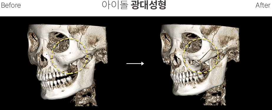 CT Scan3 Contouring Wajah Pria