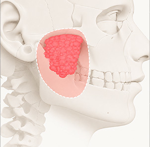 Pengurangan Lemak Pipi Bagian Dalam (Buccal Fat) - gambar detail