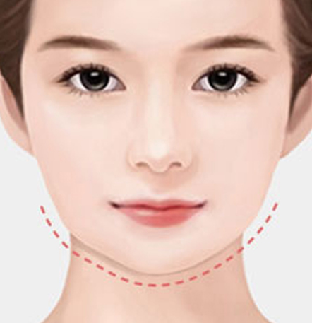 NANA Plastic Surgery<br/><b>Kapan Operasi Revisi Kontur Wajah Diperlukan?</b> - gambar detail