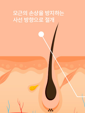 Gambar metode sayatan Forehead Reduction NANA Plastic Surgery yang menjaga akar rambut, dengan struktur sayatan miring mengikuti arah pertumbuhan rambut.