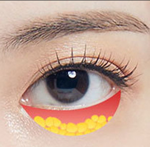 Under-Eye Fat Repositioning - gambar detail