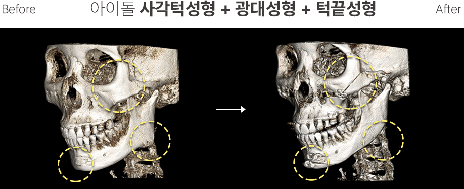 CT Scan4 Contouring Wajah Pria