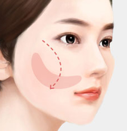 NANA Plastic Surgery<br/><b>Kapan Operasi Revisi Kontur Wajah Diperlukan?</b> - gambar detail