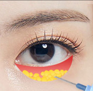 Under-Eye Fat Removal - gambar detail