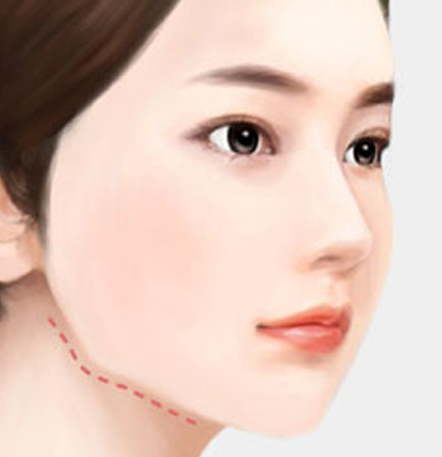 NANA Plastic Surgery<br/><b>Kapan Operasi Revisi Kontur Wajah Diperlukan?</b> - gambar detail