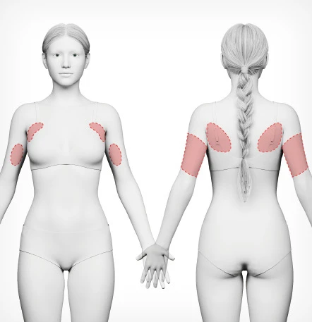 Arm Liposuction — NANA Plastic Surgery - gambar detail