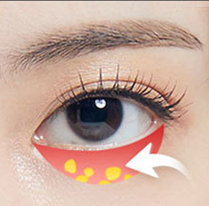 Under-Eye Fat Grafting - gambar detail