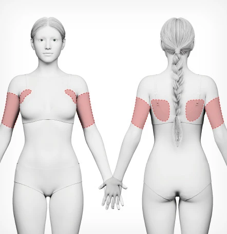 Arm Liposuction — NANA Plastic Surgery - gambar detail