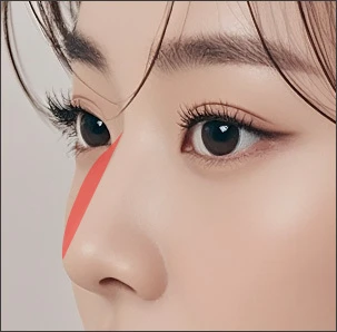 Pengangkatan Punuk Hidung - gambar detail
