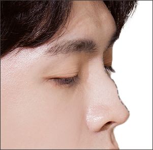 Desain 1:1 Personalized Rhinoplasty untuk Hidung Berpunuk