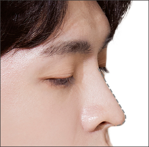 Desain 1:1 Personalized Rhinoplasty untuk Arrow Nose