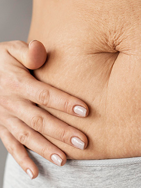 Memperbaiki Stretch Marks - gambar detail